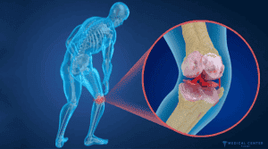 Athlete Meniscus Repair in Turkey 