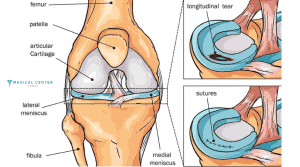 Athlete Meniscus Repair in Turkey