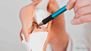 Athlete Meniscus Repair in Turkey 