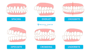Orthodontic Treatments in Turkey