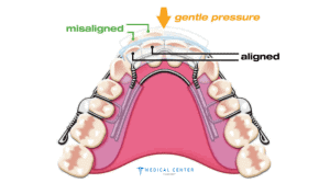 Orthodontic Treatments in Turkey