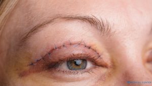 Eye Lift in 2025 Say Goodbye to Droopy Eyelids