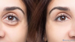 Eyelid Surgery (Blepharoplasty) Techniques in Turkey
