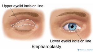 Eyelid Surgery (Blepharoplasty) Techniques in Turkey