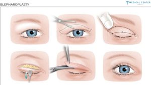 Eyelid Surgery