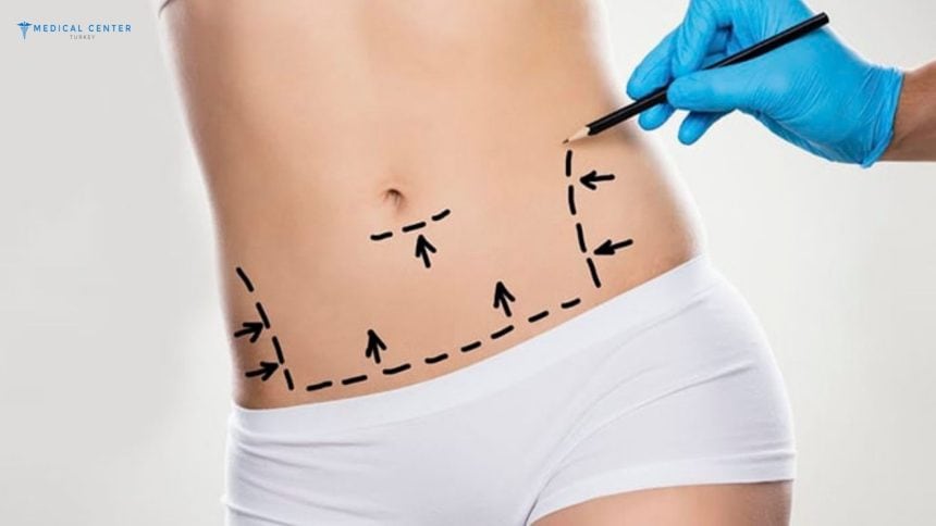 Liposuction Costs in Turkey 2024 Liposuction Costs in Turkey 2024
