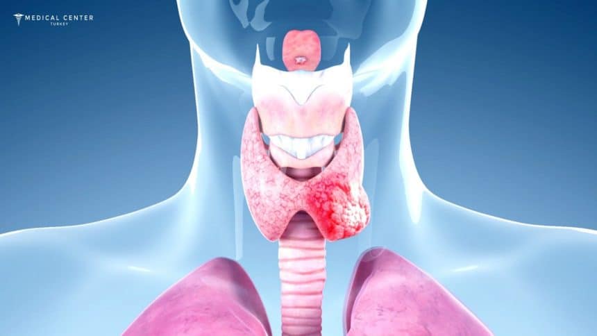 Thyroid Cancer Treatment in Turkey