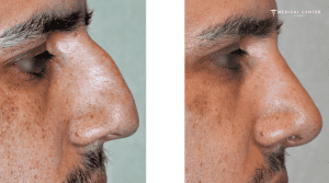 What You Need to Know Before Getting a Nose Surgery