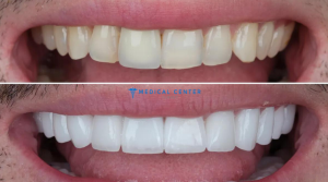 Dental Crowns in Turkey