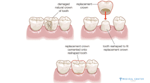 Dental Crowns in Turkey