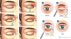 Fox Eyes Surgery in Turkey 5