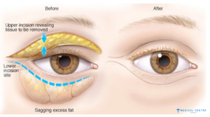 Hooded Eyes Makeup Botox Surgery 