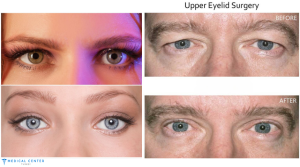 Hooded Eyes Makeup Botox Surgery 