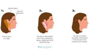 Is Neck Lift Painful 3