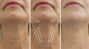 Is Neck Lift painful?