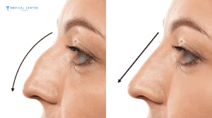 What You Need to Know Before Getting a Nose Surgery