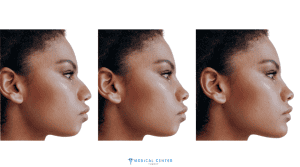 How to Choose the Right Rhinoplasty for your Face Shape