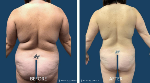 liposuction costs in Turkey 2024 