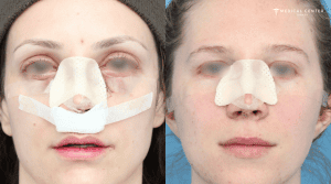 What You Need to Know Before Getting a Nose Surgery