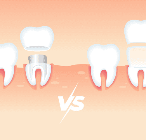 Veneers vs. Crowns: A Guide to Choosing the Best Option in Turkey