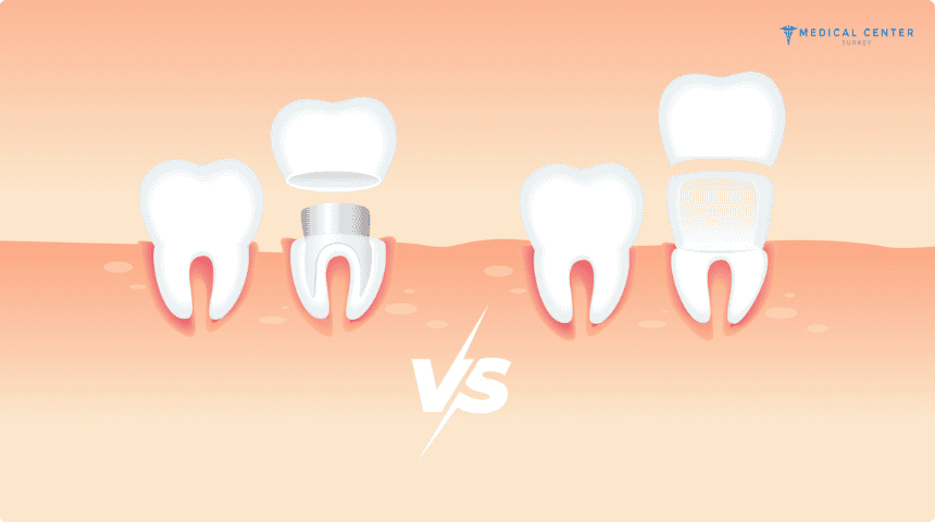 Veneers vs. Crowns: A Guide to Choosing the Best Option in Turkey Veneers vs. Crowns: A Guide to Choosing the Best Option in Turkey