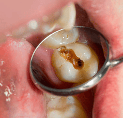 Black Teeth: Causes & Treatments in Turkey