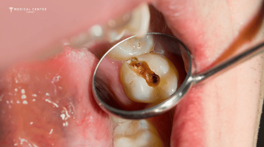 Black Teeth: Causes & Treatments in Turkey Black Teeth: Causes & Treatments in Turkey