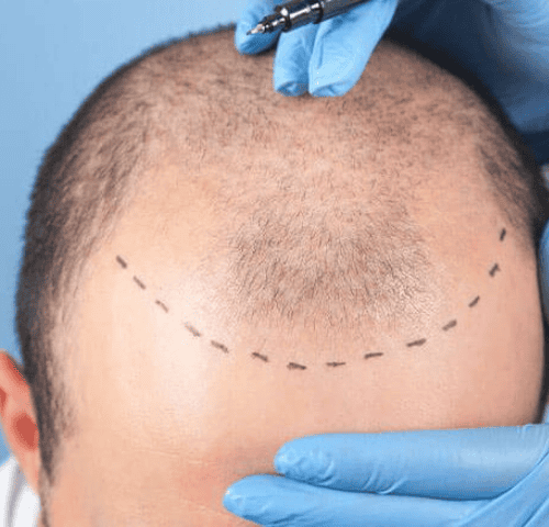 FUE Hair Transplant in Turkey 2025