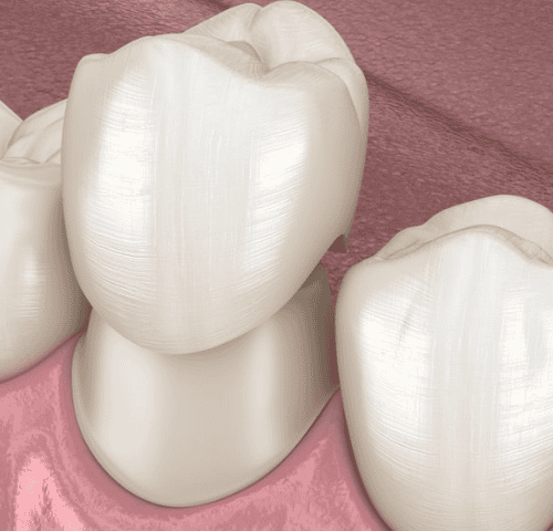How Long Does a Dental Crown Last in 2025