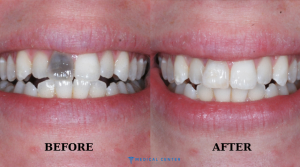 Black Teeth Causes Treatments in Turkey 2