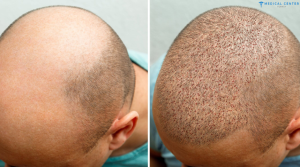FUE Hair Transplant in Turkey 2025