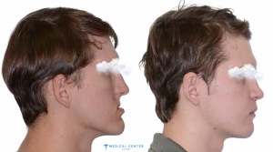 What Surgery is Best? 5 Types of Jaw Surgery in Turkey