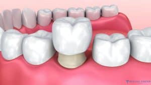 Veneers vs. Crowns: A Guide to Choosing the Best Option in Turkey