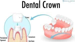 Veneers vs. Crowns: A Guide to Choosing the Best Option in Turkey