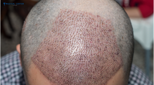 FUE Hair Transplant in Turkey 2025