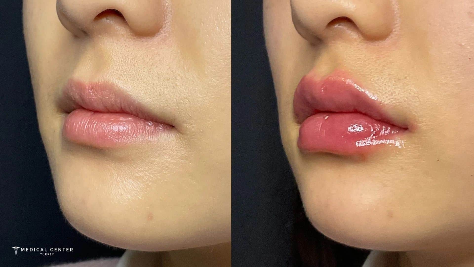How Much is a Lip Lift in Turkey?