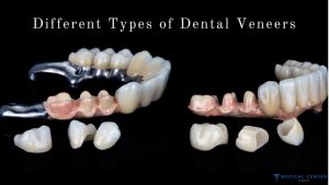Veneers vs. Crowns: A Guide to Choosing the Best Option in Turkey