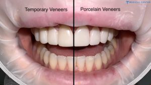 Veneers vs. Crowns: A Guide to Choosing the Best Option in Turkey
