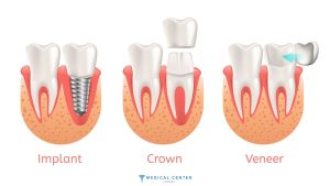 Veneers vs. Crowns: A Guide to Choosing the Best Option in Turkey