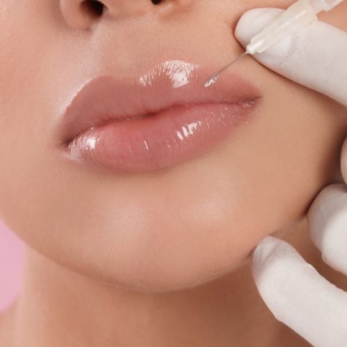 Achieving Fuller Lips with Natural Lip Fillers in Turkey Achieving Fuller Lips with Natural Lip Fillers in Turkey