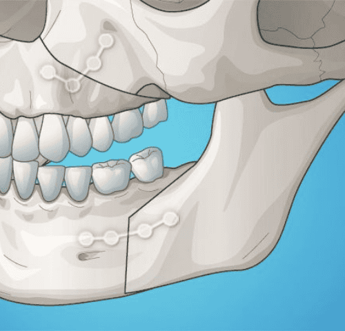 Jaw Correction Procedures in Turkey