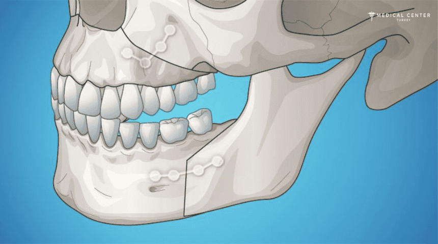 Jaw Correction Procedures in Turkey