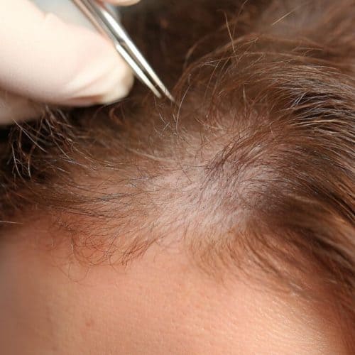Hair Transplantation in Turkey: Types, Prices, Procedures