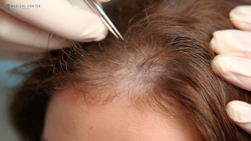 Hair Transplantation in Turkey: Types, Prices, Procedures Hair Transplantation in Turkey: Types, Prices, Procedures