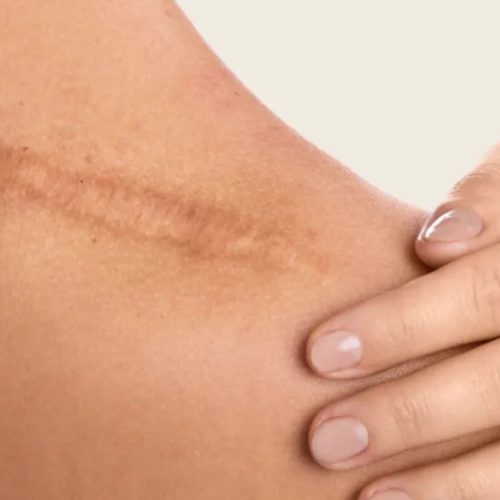 Scar Revision Surgery in Turkey and Functional Outcomes Scar Revision Surgery in Turkey and Functional Outcomes