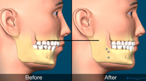 Jaw Correction Procedures in Turkey 2