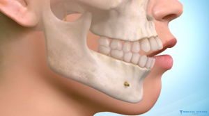 Jaw Correction Procedures in Turkey 5