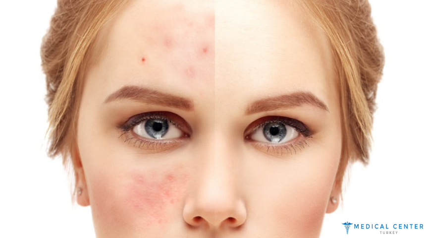 Scar Revision Surgery in Turkey and Functional Outcomes 1