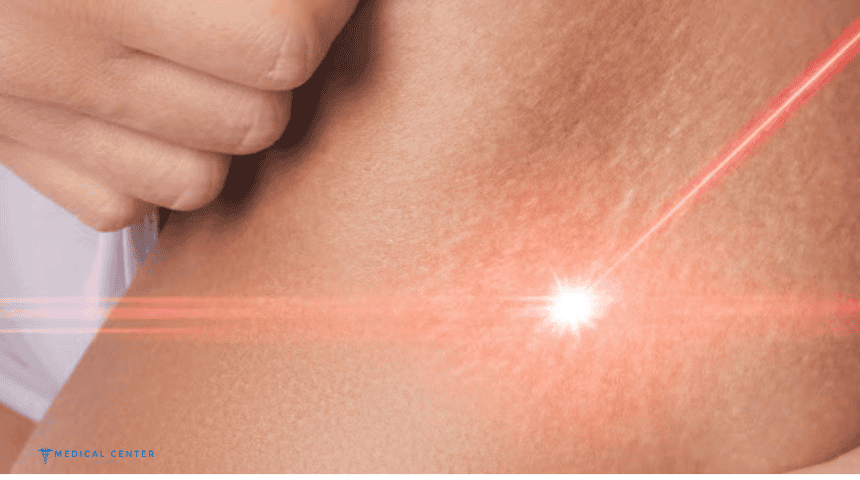 Scar Revision Surgery in Turkey and Functional Outcomes 2