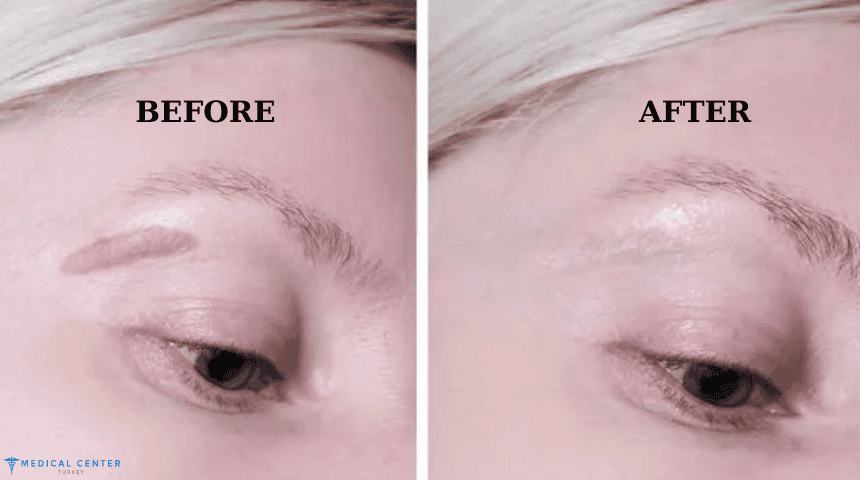 Scar Revision Surgery in Turkey and Functional Outcomes 3